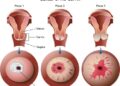 Burden of major cancer types in Almaty, Kazakhstan – Nature.com