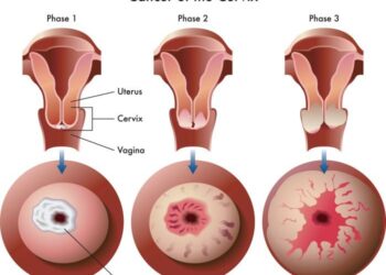 Burden of major cancer types in Almaty, Kazakhstan – Nature.com