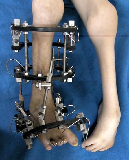 Innovative Techniques in Foot Deformity Correction Explored